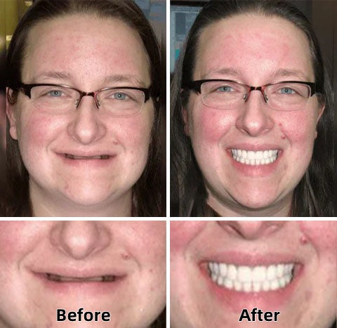 ✅🦷 Custom Functional Denture Kits – Perfect fit in Ninutes, Ready for use at Home