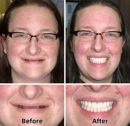 ✅🦷 Custom Functional Denture Kits – Perfect fit in Ninutes, Ready for use at Home
