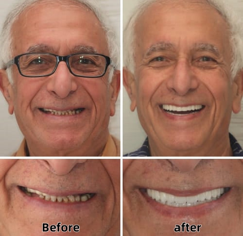 ✅🦷 Custom Functional Denture Kits – Perfect fit in Ninutes, Ready for use at Home